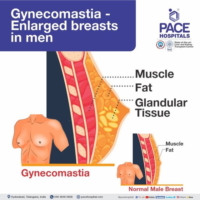 Gynecomastia Symptoms Causes Complications and Prevention